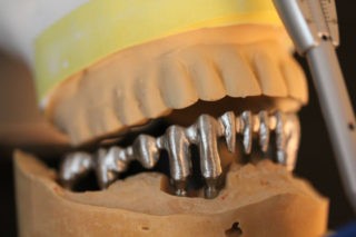 ARMATURE-DE-BRIDGE-SUR-IMPLANTS