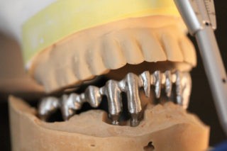 ARMATURE-DE-BRIDGE-SUR-IMPLANTS copie