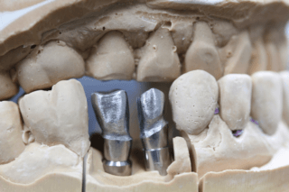 2-armatures-sur-implants