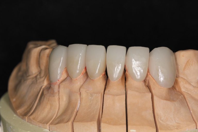 50 Boutons Linguistiques Composites Dentaires En Céramique - Base Ronde Adhésive, Pour Orthodontie, Marque AZDENT