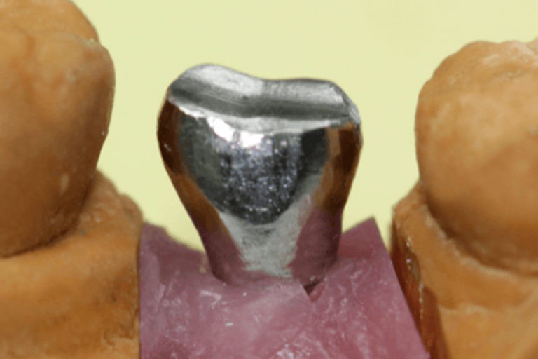 METALODONT Laboratoire de Prothèse Dentaire • Armaturesurimplant