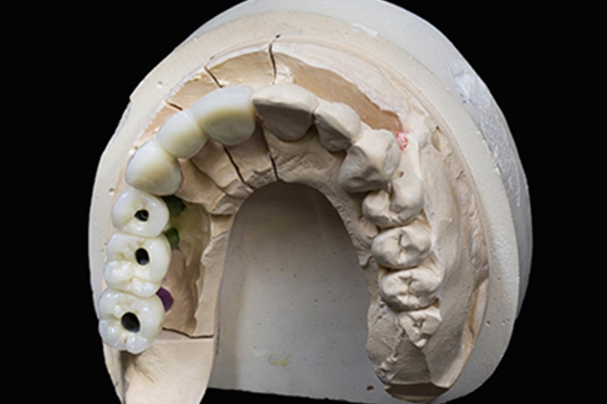 BRIDGE-CERAMIQUE-VISSE-SUR-IMPLANTS-2